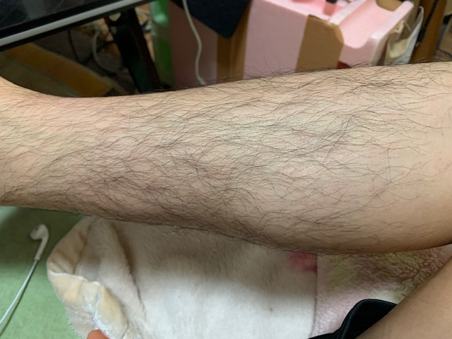 足を脱毛してみた