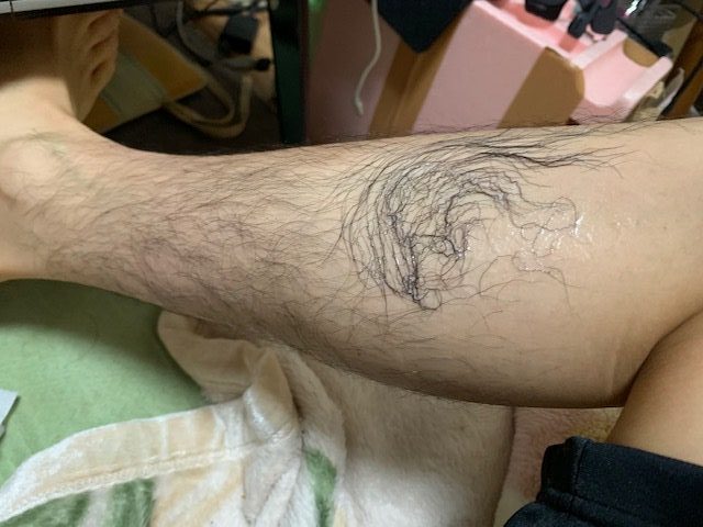 足を脱毛してみた